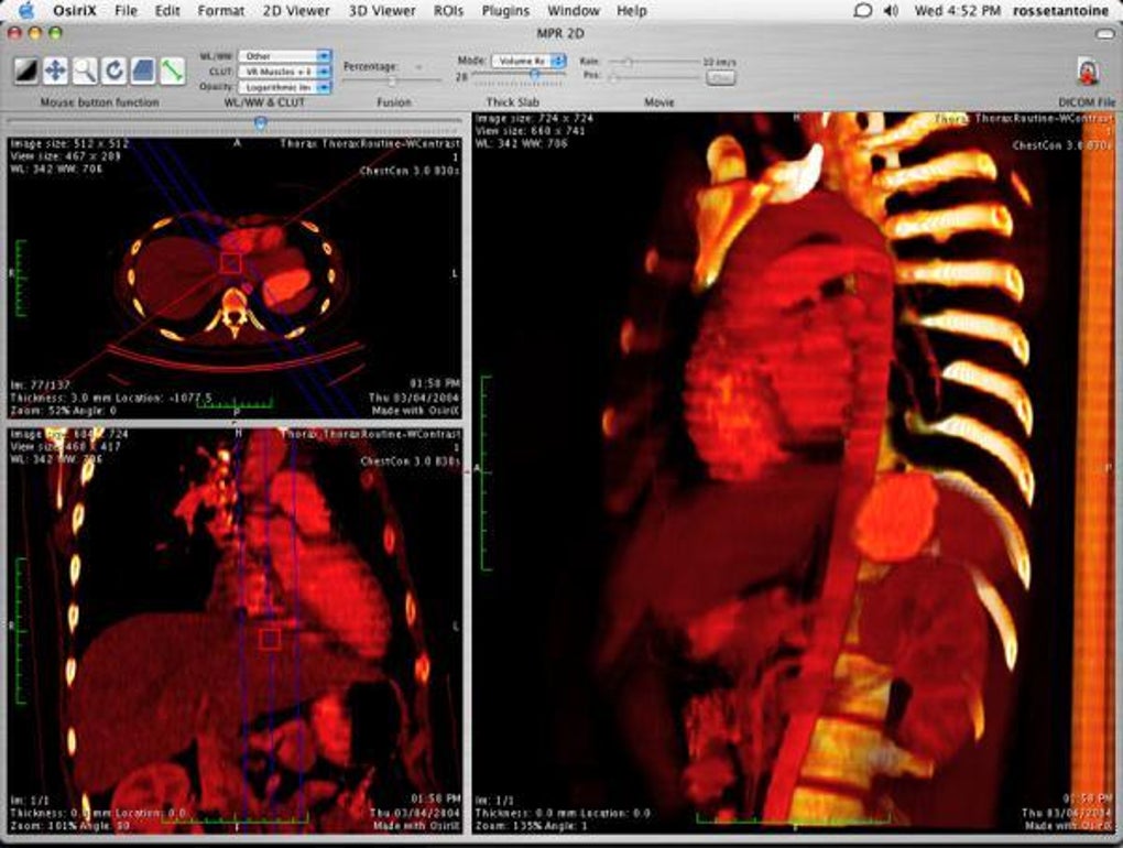 how to measure with osirix lite