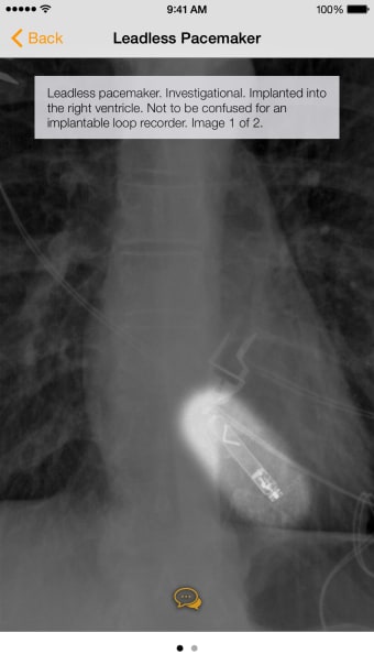 Medical Devices on Chest X-Ray