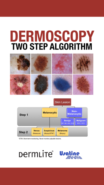 Dermoscopy Two Step Algorithm