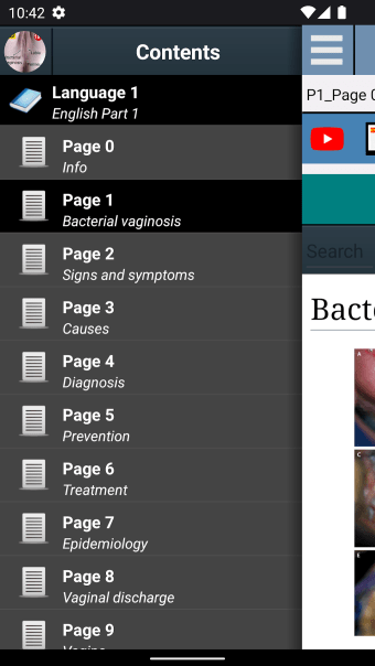 Bacterial vaginosis: Symptoms