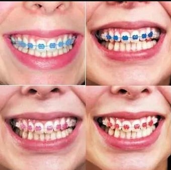 Braces