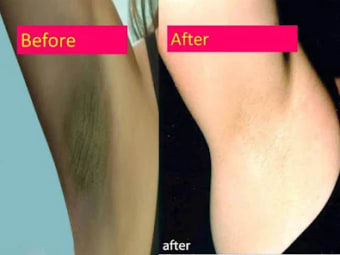 tips to get rid of dark armpit