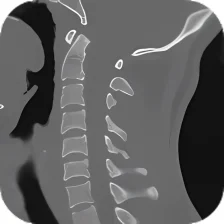 CT Cervical Spine