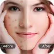 Face Blemish Remover - Smooth Skin  Beautify Face