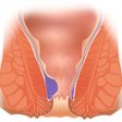 Icon of program: Геморрой. Способы лечения