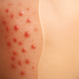 Programın simgesi: AcneTrack - Your Acne Jou…
