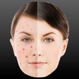 Icoon van programma: Perfect Face - Pimple Mol…
