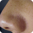プログラムのアイコン：Remove Blackheads Home Re…