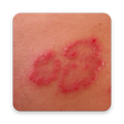 プログラムのアイコン：How to Cure Skin Rashes
