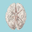 Cerebrovascular  Stroke: WTD